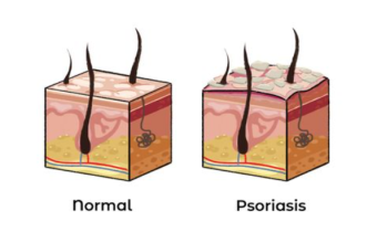 Liečba včelím jedom na Psoriázu